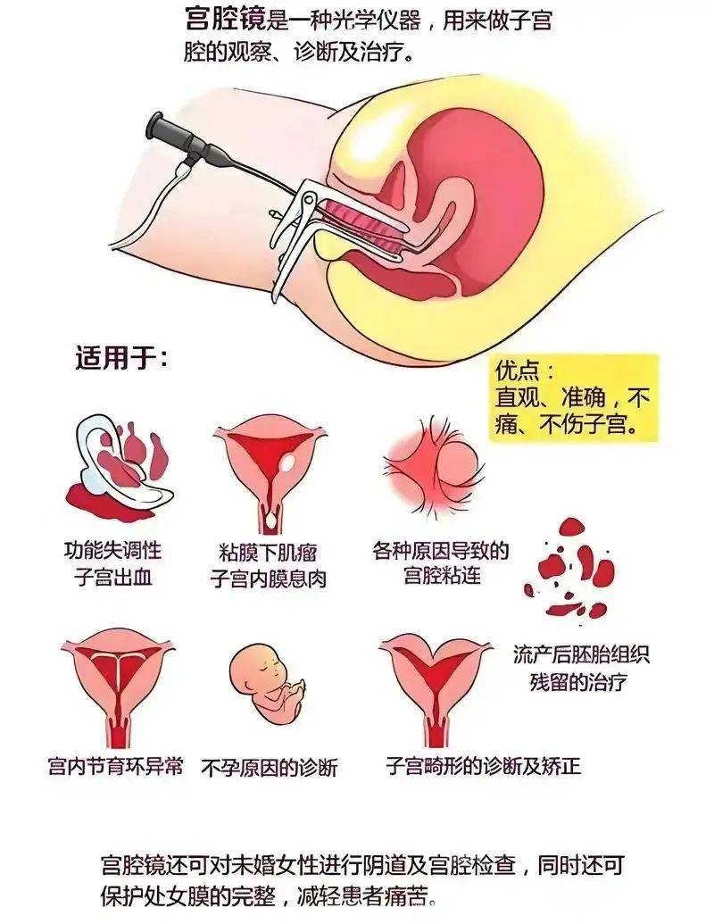 宫腔镜手术:窥探女性健康的隐形之眼